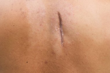 Kaldırılmış yara izi. Apandisit sonrası yara izi. Ameliyat ve dikişlerden kaynaklanan siyanotik keloit izi, deri kusurları veya kusurlar. Deride hipertrofik yara izi