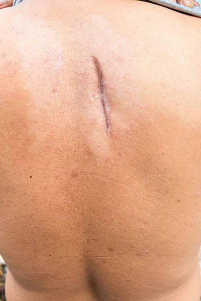 Raised Scar Scar Appendectomy Cyanotic Keloid Scar Caused Surgery Suturing — Stockfoto