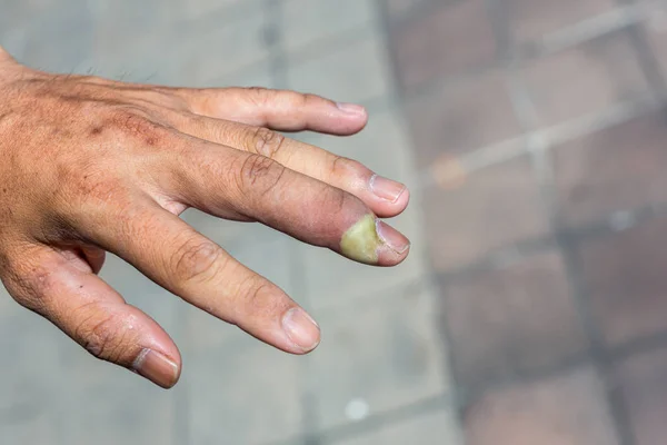 Paronychia Gezwollen Vinger Met Vingernagel Bed Ontsteking Als Gevolg Van — Stockfoto