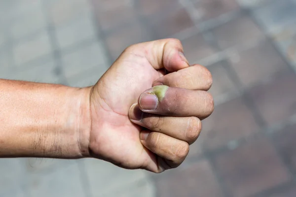 Paronychia Küçük Çocuklar Elinde Bakteriyel Enfeksiyon Nedeniyle Tırnak Yatağı Iltihabı — Stok fotoğraf