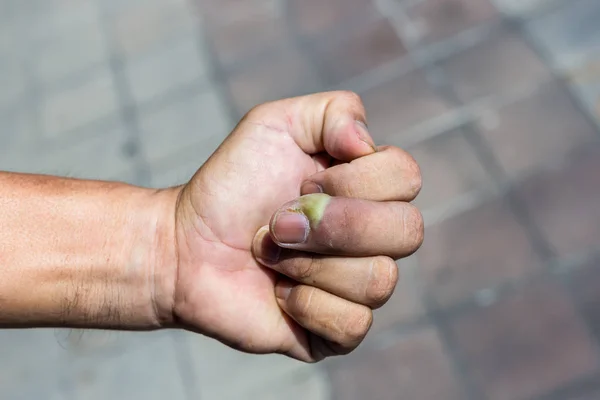 Paronychia Küçük Çocuklar Elinde Bakteriyel Enfeksiyon Nedeniyle Tırnak Yatağı Iltihabı — Stok fotoğraf