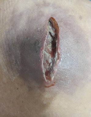 Surgical wound  large abscess with surrounding cellulitis. Huge upper back abscess require drainage in diabetic patient.