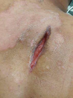 Surgical wound  large abscess with surrounding cellulitis. Huge upper back abscess require drainage in diabetic patient.