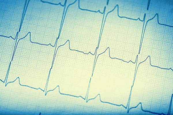 EKG grafiği. Elektrokardiyogram ekg EKG