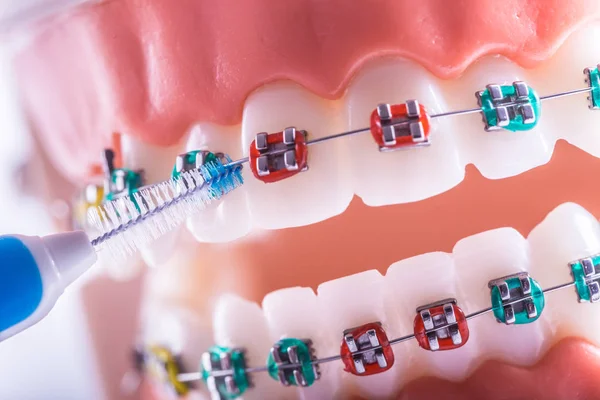 Modelo de dente de aparelhos dentários com escova de limpeza de dentes dentários inter — Fotografia de Stock