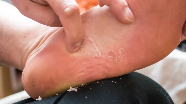 Aproape de o infecție a piciorului numit. Este o infecție fungică — Fotografie, imagine de stoc