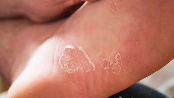 a man scratches the fungal infection between his toes