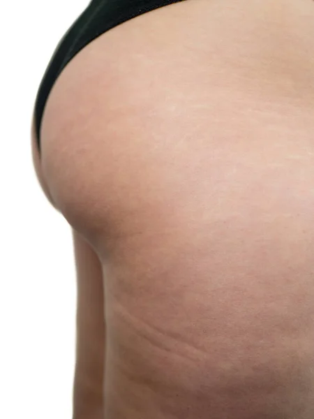 Vrouwelijke dijbenen met cellulitis. Huidprobleem, onderwerp, explosief gewicht en dieet, risicofactor diabetes — Stockfoto
