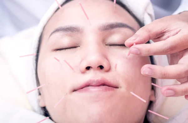 the facial acupuncture on a woman face in clinic