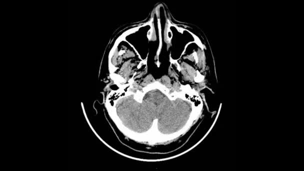 Scan Computed Tomography Skull — Stock Video