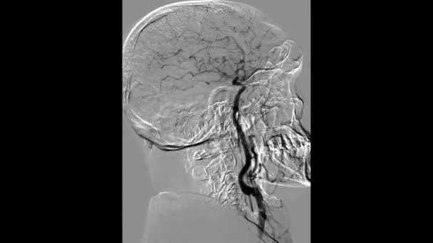 Angiografia Coronária Exame Radiográfico — Vídeo de Stock
