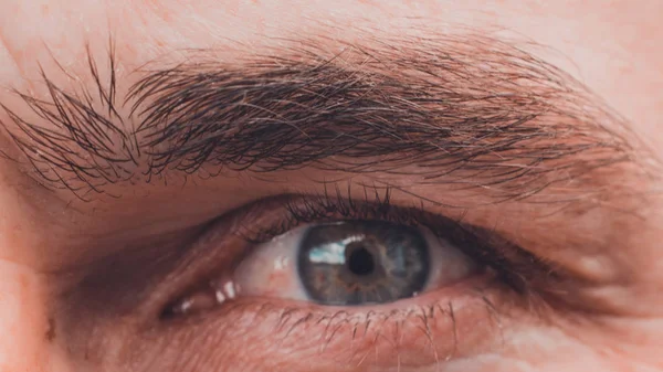 Closeup of male eye, conjunctivitis and freckles. — Stock Photo, Image