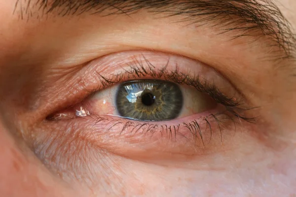 Close-up, clearly expressed conjunctivitis and redness on the eye. — Stock Photo, Image