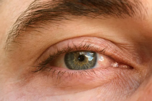 Close-up, clearly expressed conjunctivitis and redness on the eye. — Stock Photo, Image