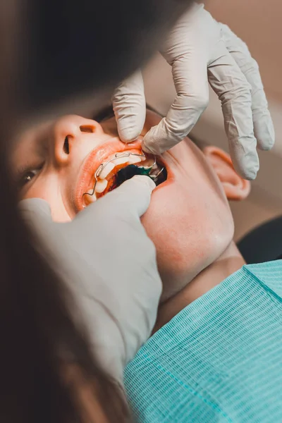 O menino com a boca aberta jaz na cadeira do dentista enquanto o ortodontista segura a placa nos dentes. . — Fotografia de Stock