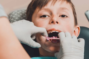 Ağzında diş izi tepsisiyle dişçi koltuğunda oturan çocuk.