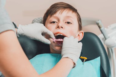 Ağzında diş izi tepsisiyle dişçi koltuğundaki çocuk 2020.