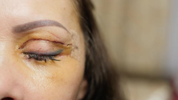 Olho do paciente após cirurgia plástica, close-up — Vídeo de Stock