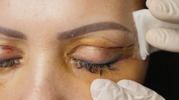 Lubrication wounds after blepharoplasty eyelids
