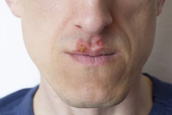 Opryszczka Ustach Mężczyzny — Zdjęcie stockowe