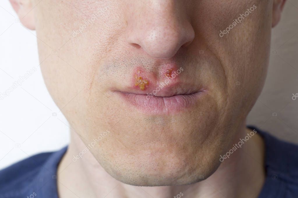 Herpes on the lips of a man.