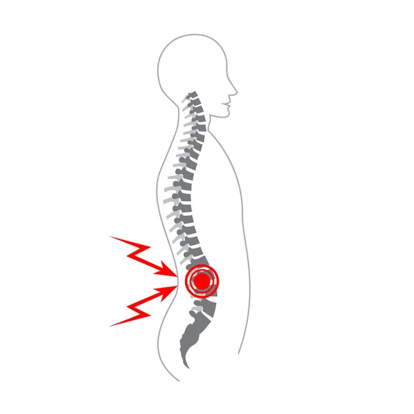 Ilustración Del Vector Del Dolor Columna Vertebral Humana Banner Médico — Vector de stock