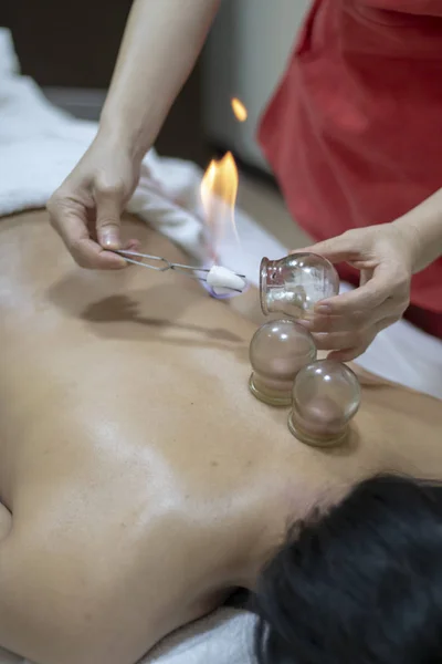 Acupuncture therapist removing a fire cupping glass