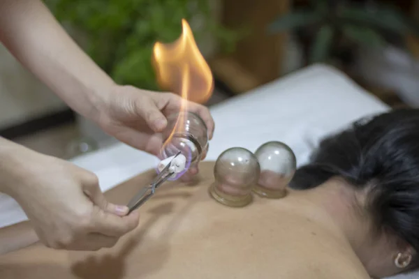 Akupunkturní terapeut zapalující sklenici na záda mladé ženy — Stock fotografie