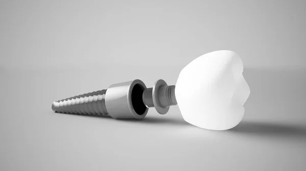 Rendu Prothèse Implant Dentaire — Photo