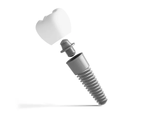 Rendering Dental Implant Prosthesis Future Healthcare — Stock Photo, Image