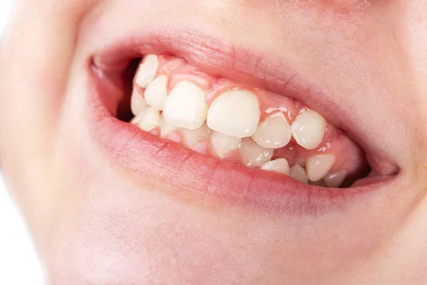 Boca adolescente con dientes torcidos permanentes —  Fotos de Stock
