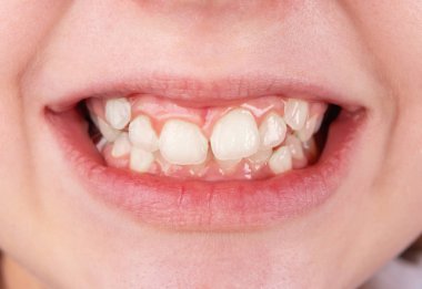 Çürük dişleri olan bir ergen ağzı.