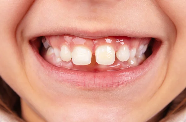 Mond van een kind met permanente gebarsten tanden — Stockfoto