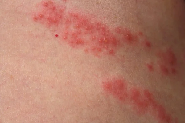 Herpes Zoster Tıp Sağlık Cilt Üzerinde Kadar Yakın — Stok fotoğraf