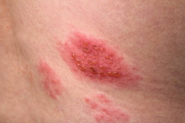 Herpes Zoster. Tıp ve sağlık, cilt üzerinde kadar yakın