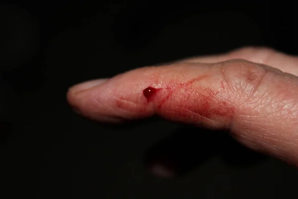 Tangan Manusia Dengan Cedera Menutup — Stok Foto