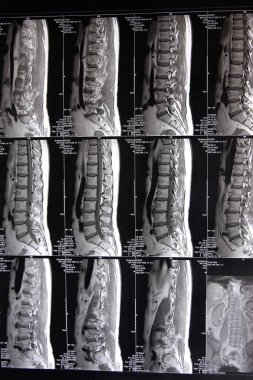 Manyetik rezonans tomografisi yakın atış
