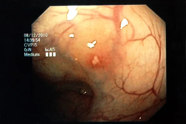 Endoscopia Primo Piano Colpo — Foto Stock