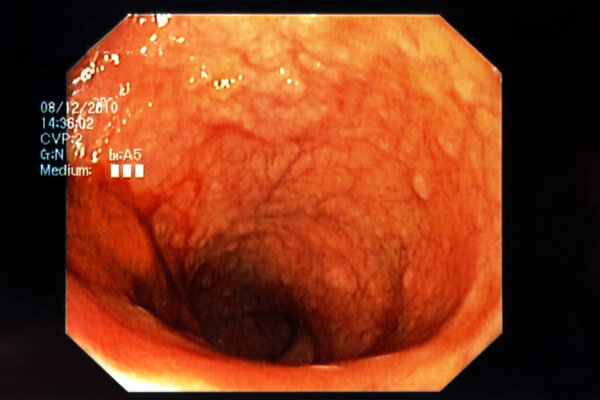 Эндоскопия крупным планом
