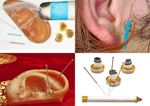 Concepto Medicina Para Acupuntura Del Oído —  Fotos de Stock