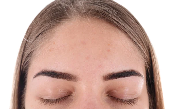 Jovem com problema de acne no fundo branco — Fotografia de Stock