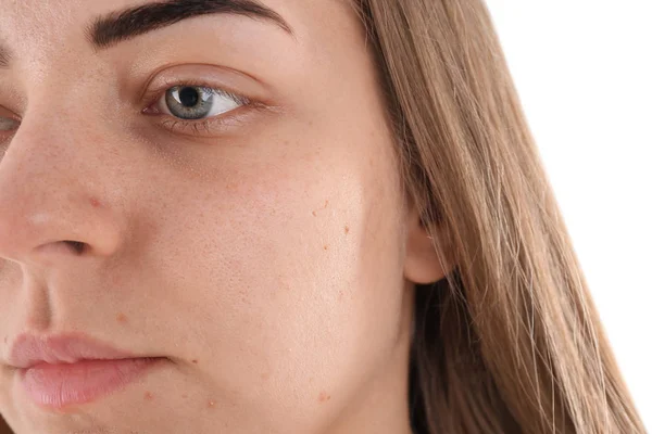 Mujer joven con problemas de acné sobre fondo blanco — Foto de Stock