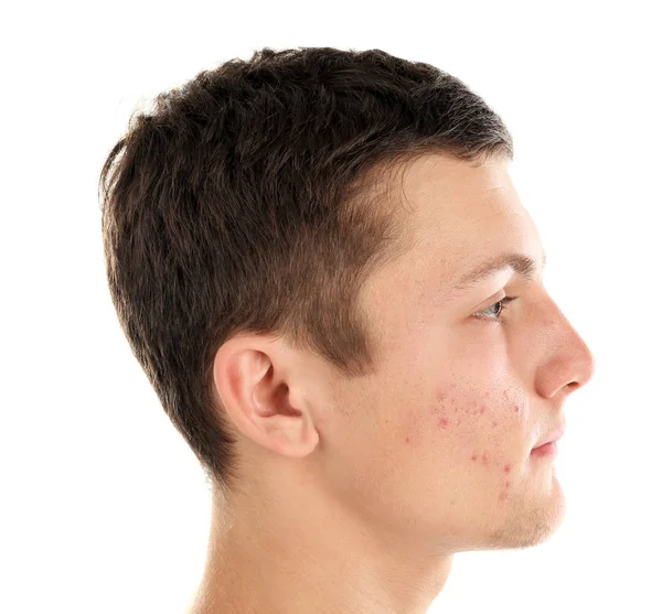 Hombre joven con acné problema sobre fondo blanco — Foto de Stock