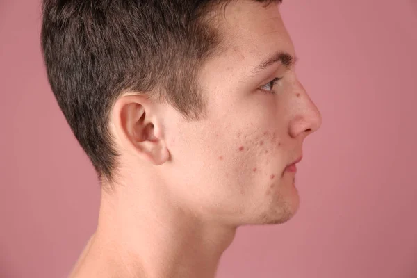 Jovem com problema de acne no fundo da cor — Fotografia de Stock