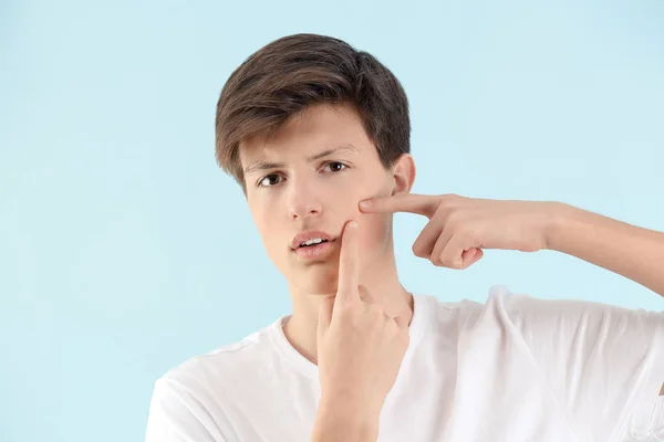 Menino adolescente com problema de acne no fundo claro — Fotografia de Stock