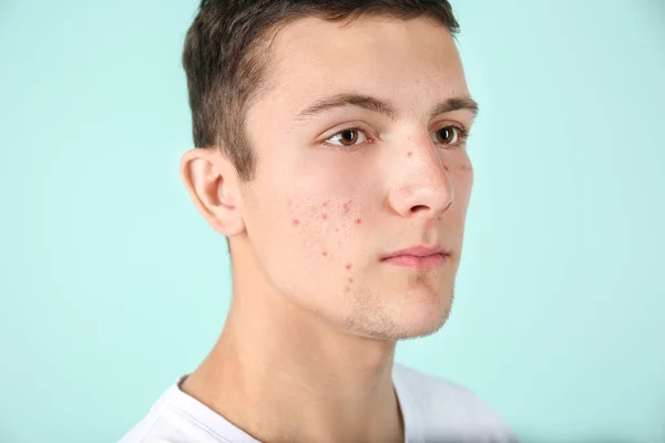 Young man with acne problem on color background — Stock Photo, Image