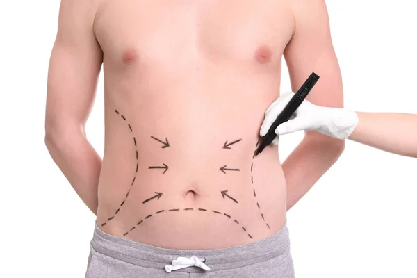 Doctor drawing lines on man's stomach with marker against white background — Stock Photo, Image