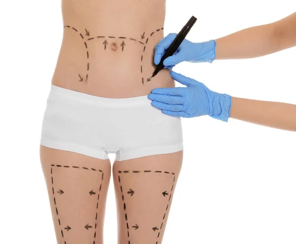 Marcas de dibujo del médico en el vientre femenino para la operación de cirugía estética contra fondo blanco — Foto de Stock