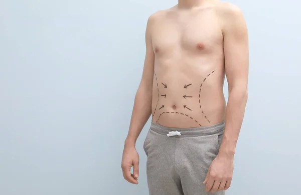 Mladý muž se značkami na břicho pro kosmetické chirurgie operace na světlé pozadí — Stock fotografie