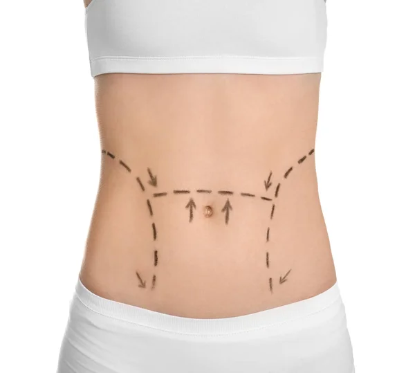 Young woman with marks on belly for cosmetic surgery operation against white background — Stock Photo, Image